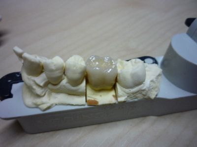 Protesi dentarie, ponti, corone a basso costo